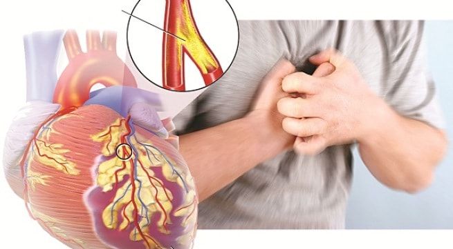 Dấu hiệu sớm của bệnh động mạch